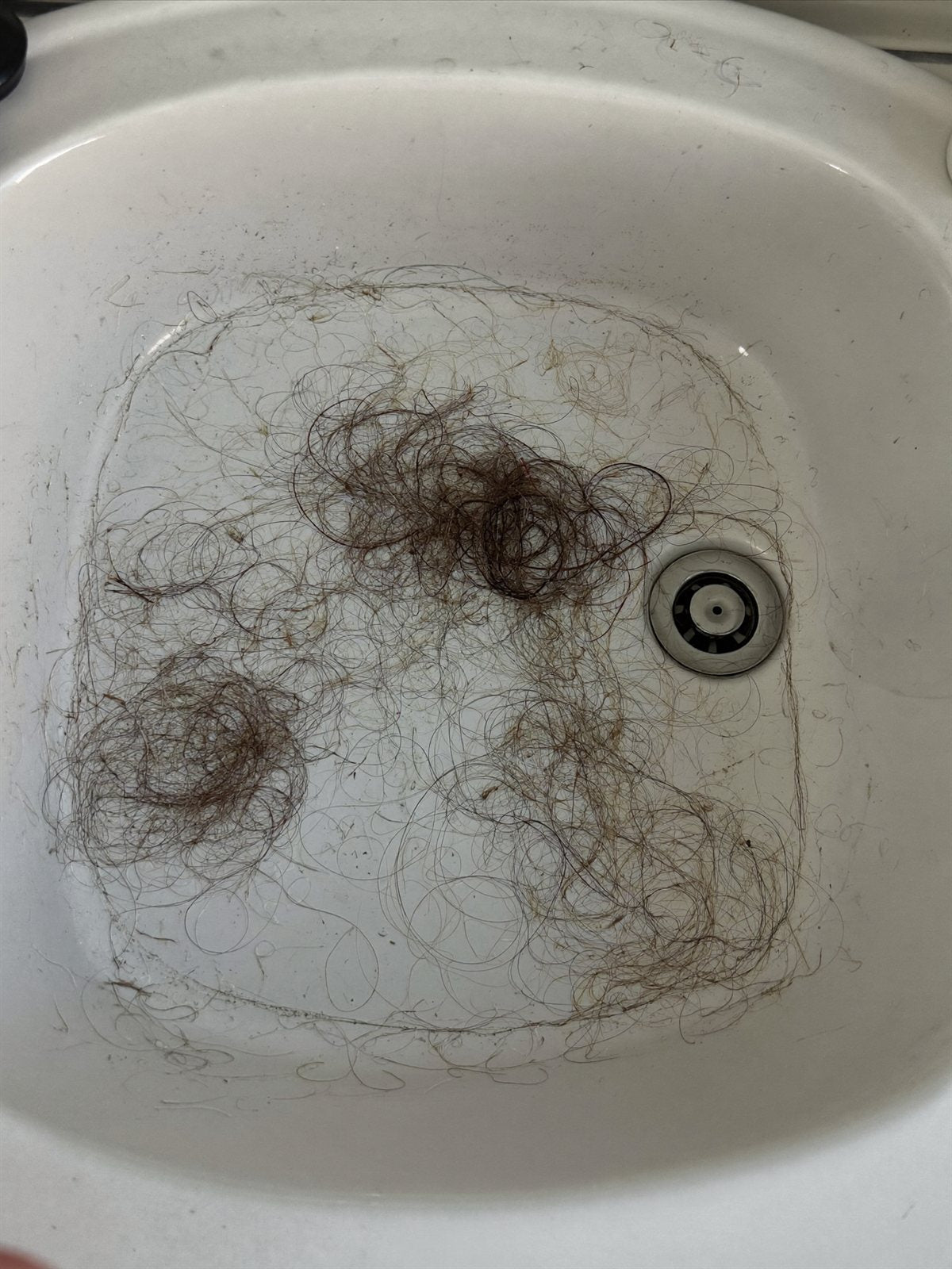 Hair collected at the sink during rapid weight loss